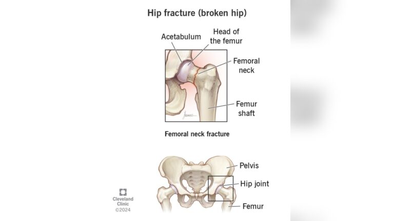 can-u-walk-on-a-broken-hip.jpg