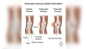 can-you-walk-on-a-dislocated-knee.jpg
