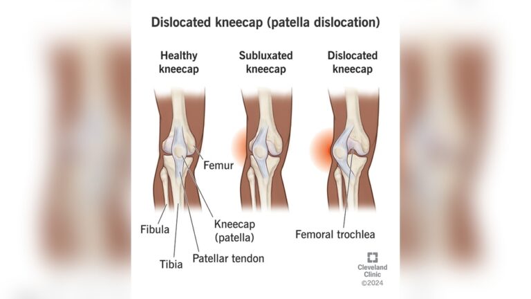 can-you-walk-on-a-dislocated-knee.jpg