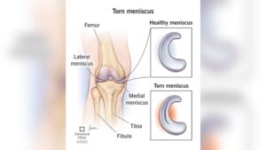 can-you-walk-on-a-torn-meniscus.jpg