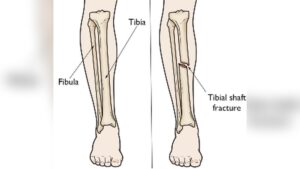 can-you-walk-with-fractured-tibia.jpg