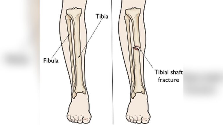 can-you-walk-with-fractured-tibia.jpg